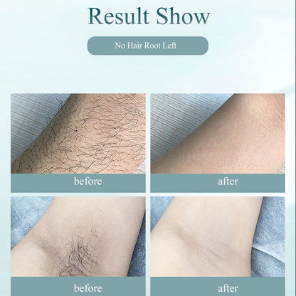 Luxe Model IPL Device with 1 M Flashes & Auto Feature