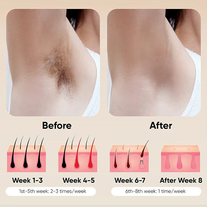 lovi Flash IPL Laser Hair Removal Device With 1 Million Flashes with Auto Features