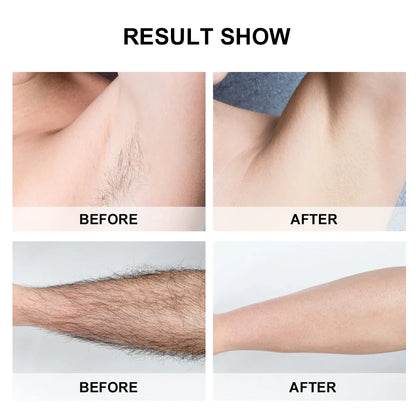 lovi Flash IPL Laser Hair Removal Device With 1 Million Flashes with Auto Features
