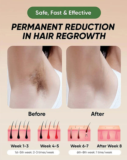 Luxe Model IPL Device with 1 M Flashes & Auto Feature
