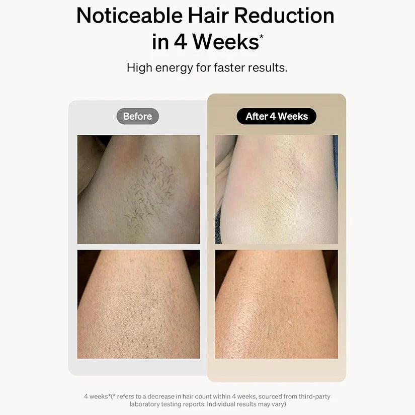 lovi Flash IPL Laser Hair Removal Device With 1 Million Flashes with Auto Features